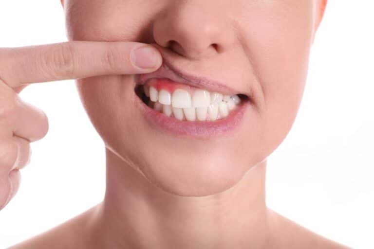 Gengivoplastia
