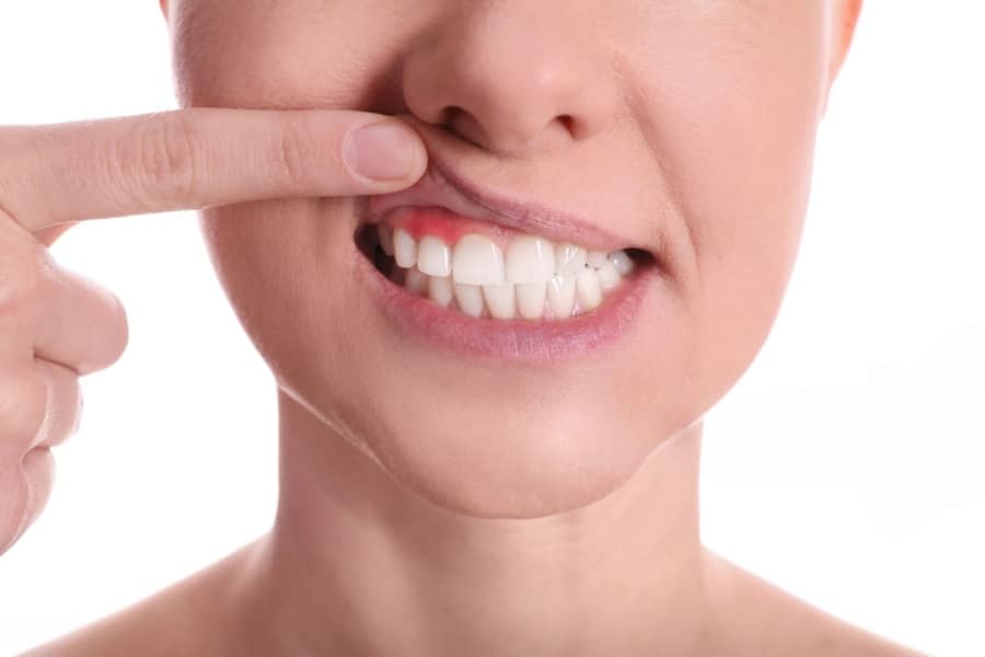 Gengivoplastia