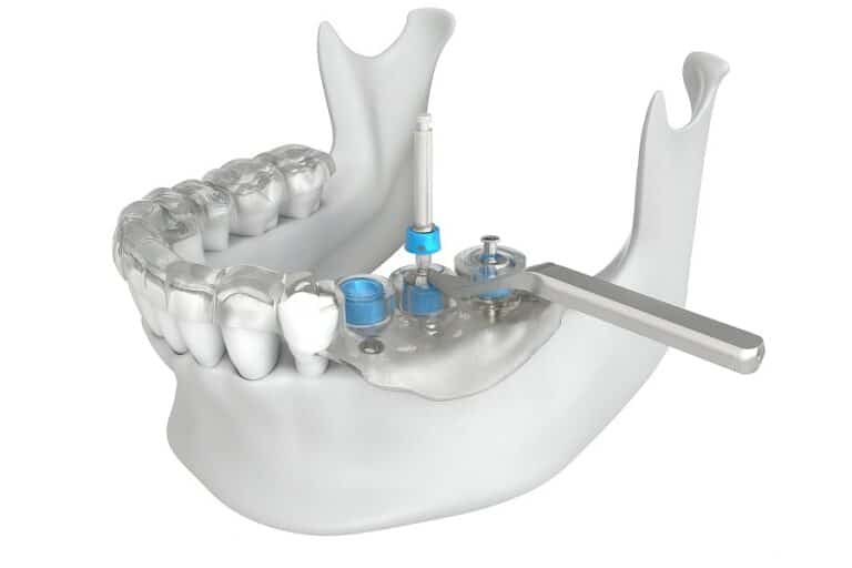 Cirurgia guiada