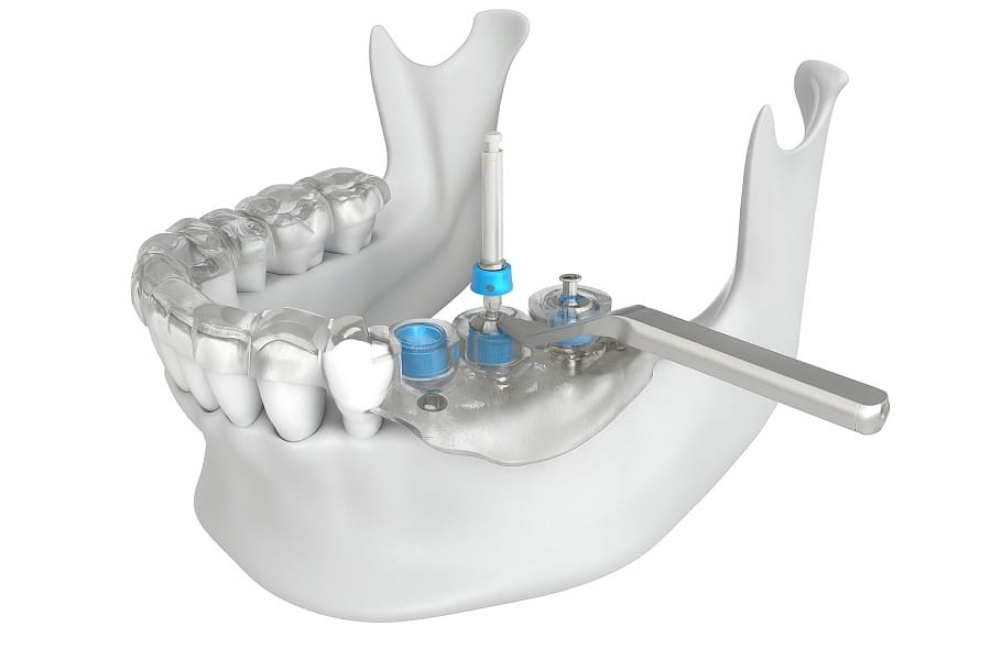 Cirurgia guiada