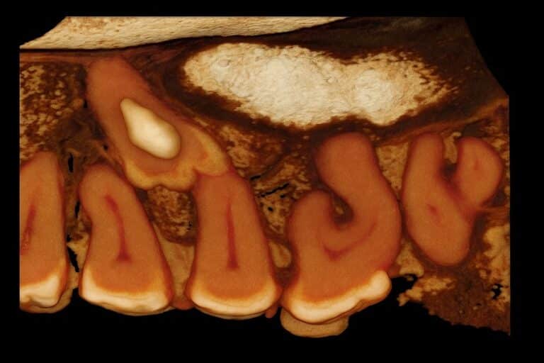 Dentes supranumerários