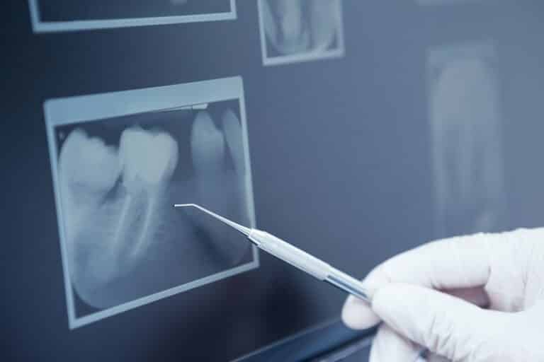 Radiografia periapical