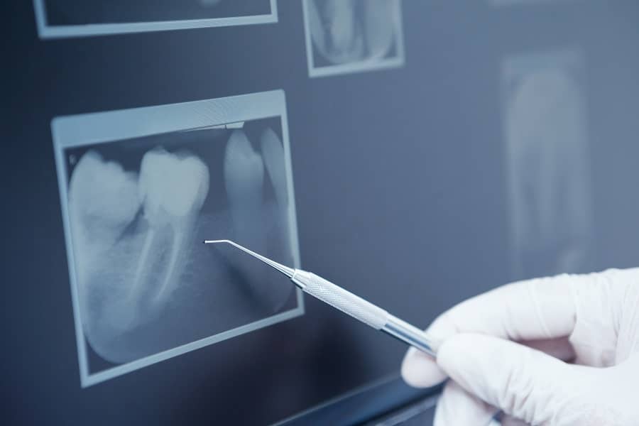 Radiografia periapical